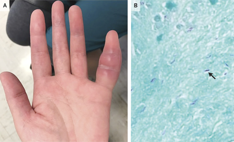 Tuberculosis of the Finger